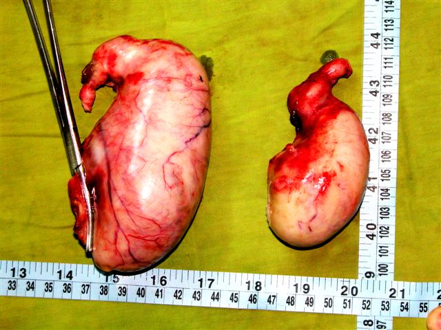 Large Hydrosalpinx both tubes